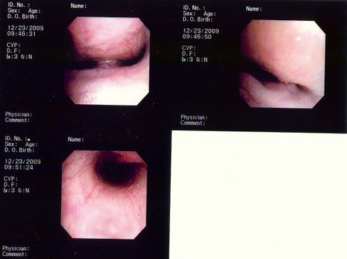 Sol trachea scope